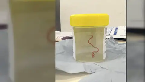 Gusano encontrado en el cerebro de una mujer Gusano encontrado en el cerebro de una mujer