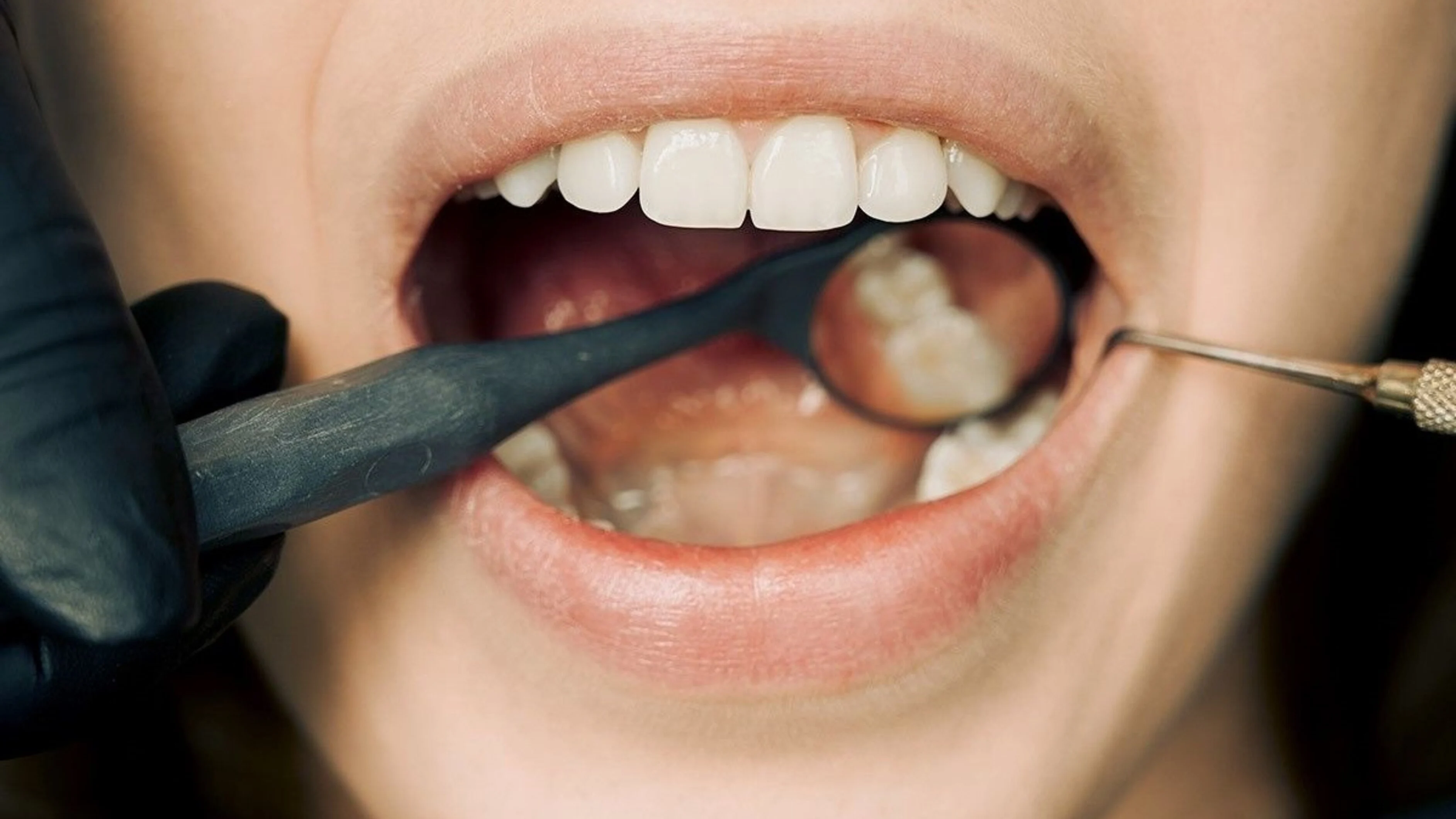 Blanqueamiento dental Blanqueamiento dental