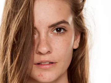 Una mujer con acné en el rostro. Una mujer con acné en el rostro.