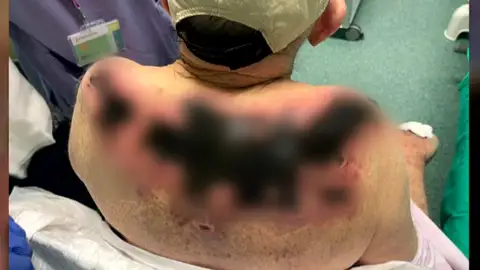 Un hombre de 92 años con Alzheimer sufre quemaduras de segundo grado tras ser olvidado al sol en una residencia Un hombre de 92 años con Alzheimer sufre quemaduras de segundo grado tras ser olvidado al sol en una residencia