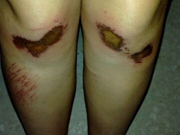 Heridas de la joven que ha denunciado un agresión en Sevilla