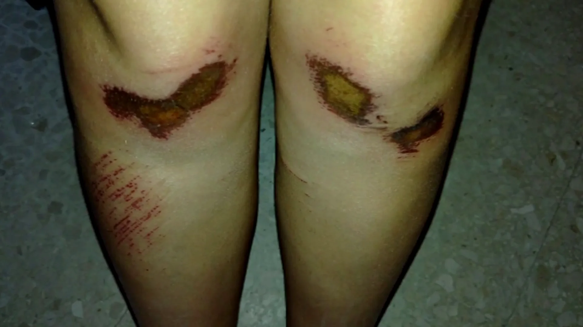 Heridas de la joven que ha denunciado un agresión en Sevilla Heridas de la joven que ha denunciado un agresión en Sevilla