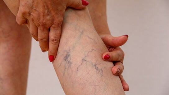 Varices