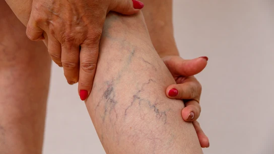 Varices Varices