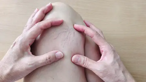 Pierna con varices Pierna con varices