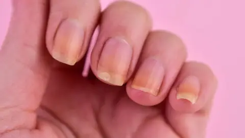 Uñas con color amarillento Uñas con color amarillento