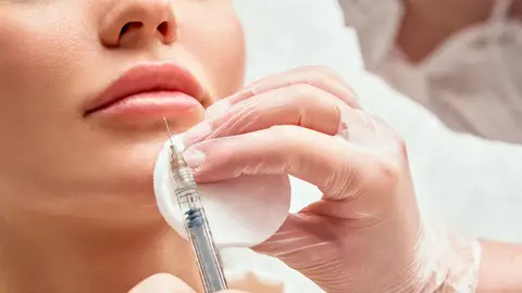 Inyección de ácido hialurónico en los labios Inyección de ácido hialurónico en los labios