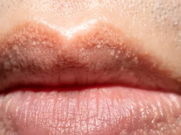 Manchas o granos Fordyce en los labios Manchas o granos Fordyce en los labios