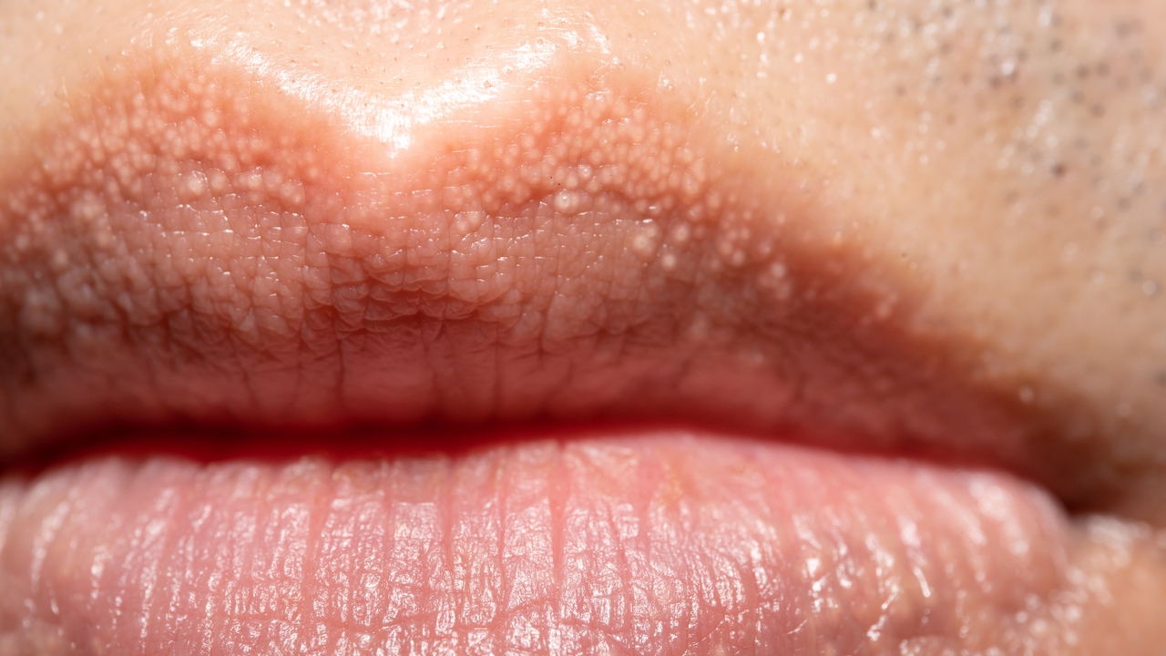 Qu Son Las Manchas O Granos De Fordyce qu-son-las-manchas-o-granos-de-fordyce