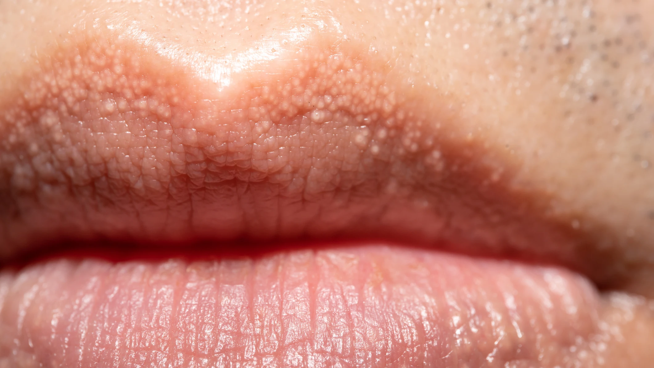 Manchas o granos Fordyce en los labios