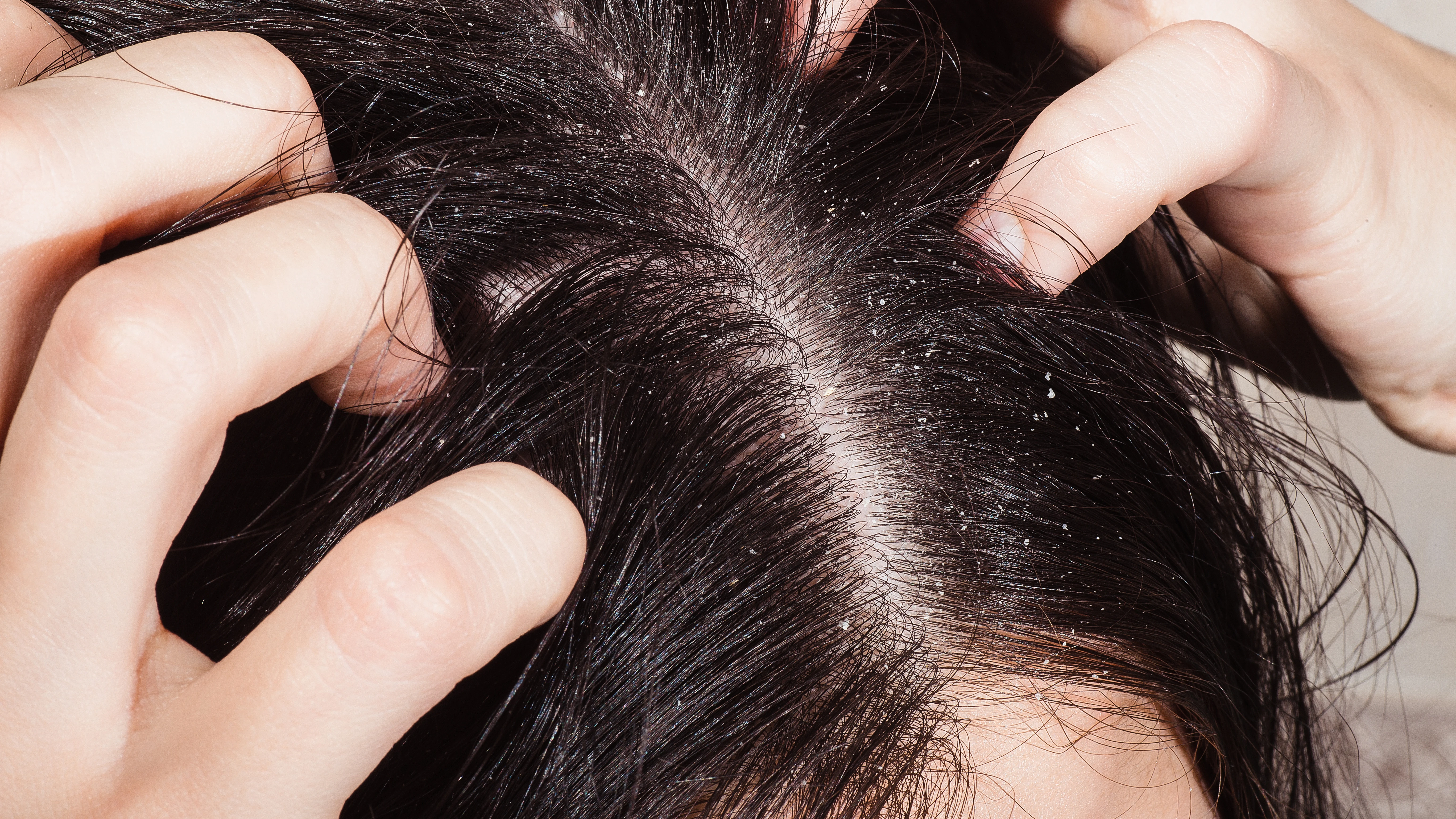 La caspa es dermatitis seborreica La caspa es dermatitis seborreica