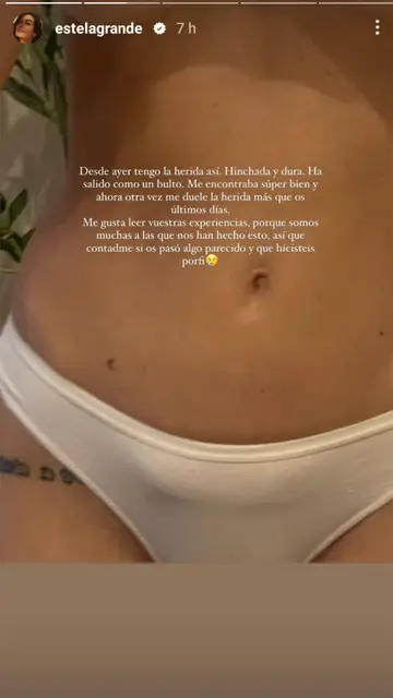 Estela Grande enseña su cicatriz Estela Grande enseña su cicatriz