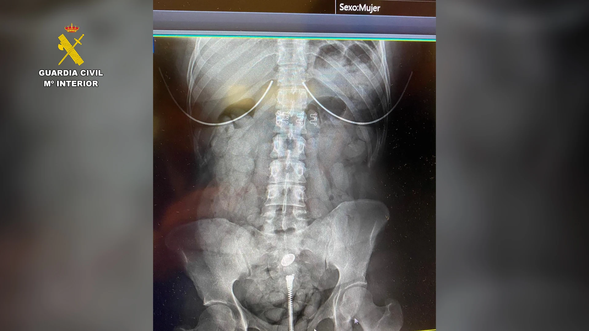 tres personas mayores de edad fueron sometidas a pruebas radiol&oacute;gicas en un hospital, dando como resultado que todos hab&iacute;an ingerido sustancias extra&ntilde;as y que las portaban dentro de su organismo