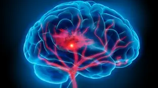 accidente cerebrovascular accidente cerebrovascular