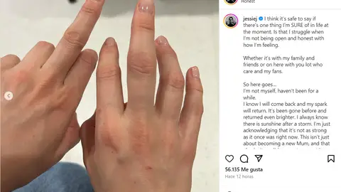 La mano de Jessie J después de caerse del escenario La mano de Jessie J después de caerse del escenario