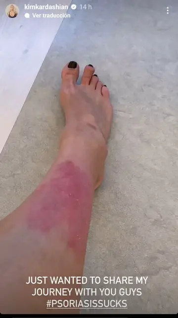 Kim Kardashian muestra las manchas causadas por su psoriasis Kim Kardashian muestra las manchas causadas por su psoriasis