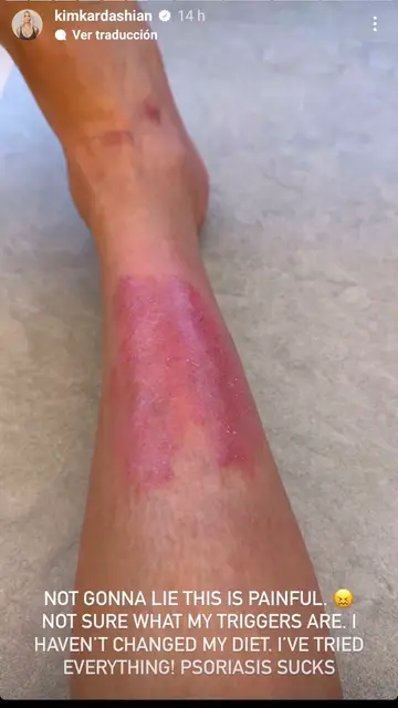 Kim Kardashian muestra las manchas causadas por su psoriasis Kim Kardashian muestra las manchas causadas por su psoriasis