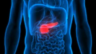 Cáncer de páncreas Cáncer de páncreas