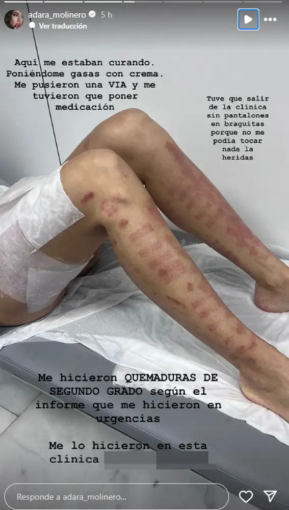 Adara Molinero enseña las quemaduras de sus piernas
