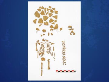Esqueleto de un niño con síndrome de Down que murió en torno a las 26 semanas de edad gestacional