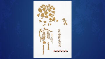Esqueleto de un niño con síndrome de Down que murió en torno a las 26 semanas de edad gestacional