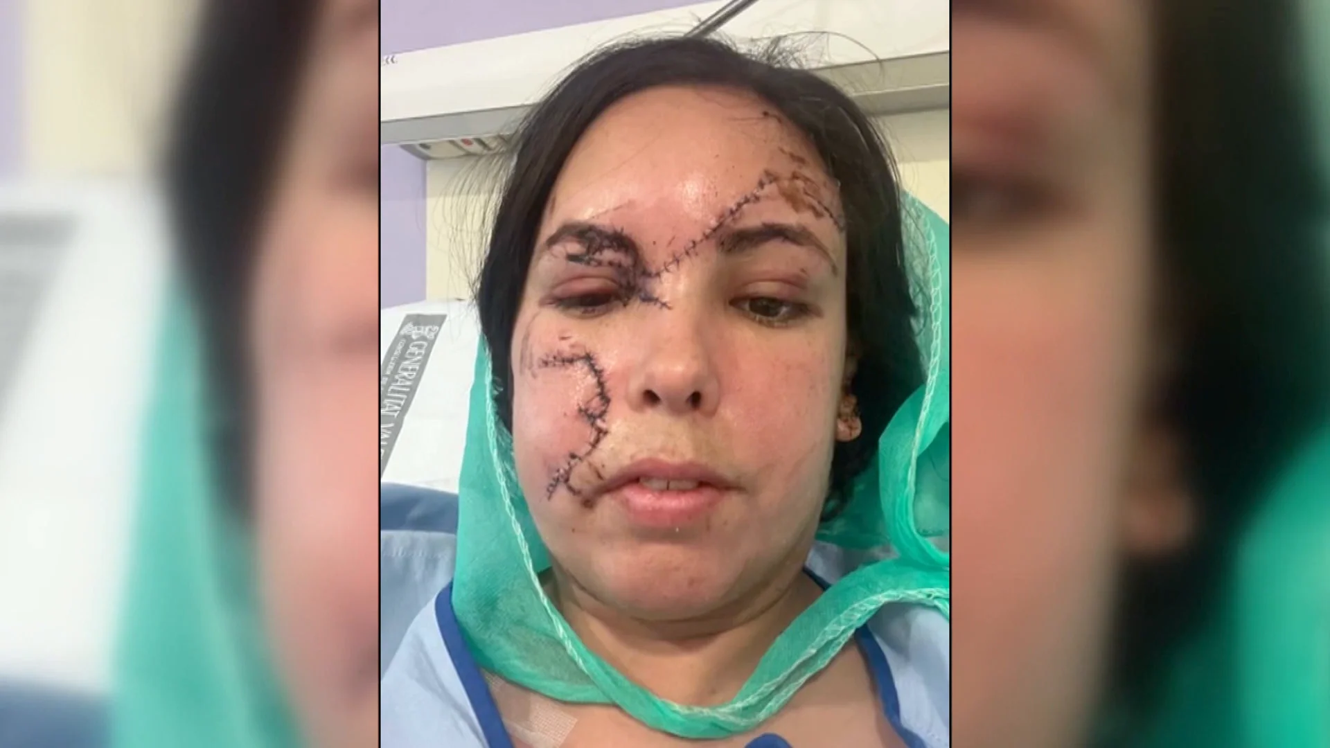 Milena, al borde de la muerte por el ataque del perro de un amigo: "Ni los m&eacute;dicos saben los puntos que me han echado"