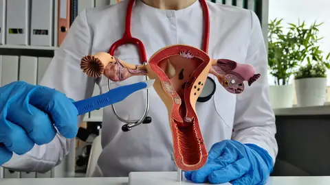 Endometriosis Endometriosis