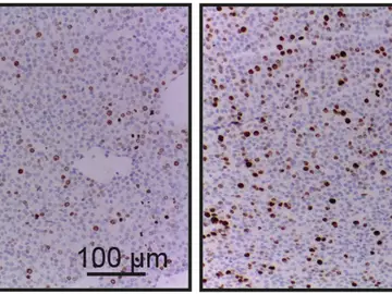 Demuestran la participación del gen ‘NCAPH’ en el pronóstico y evolución de un tipo de cáncer de mama Demuestran la participación del gen ‘NCAPH’ en el pronóstico y evolución de un tipo de cáncer de mama