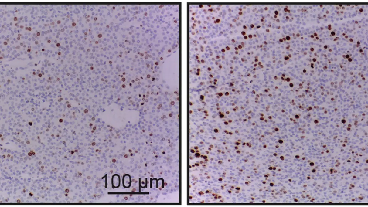 Demuestran la participación del gen ‘NCAPH’ en el pronóstico y evolución de un tipo de cáncer de mama Demuestran la participación del gen ‘NCAPH’ en el pronóstico y evolución de un tipo de cáncer de mama