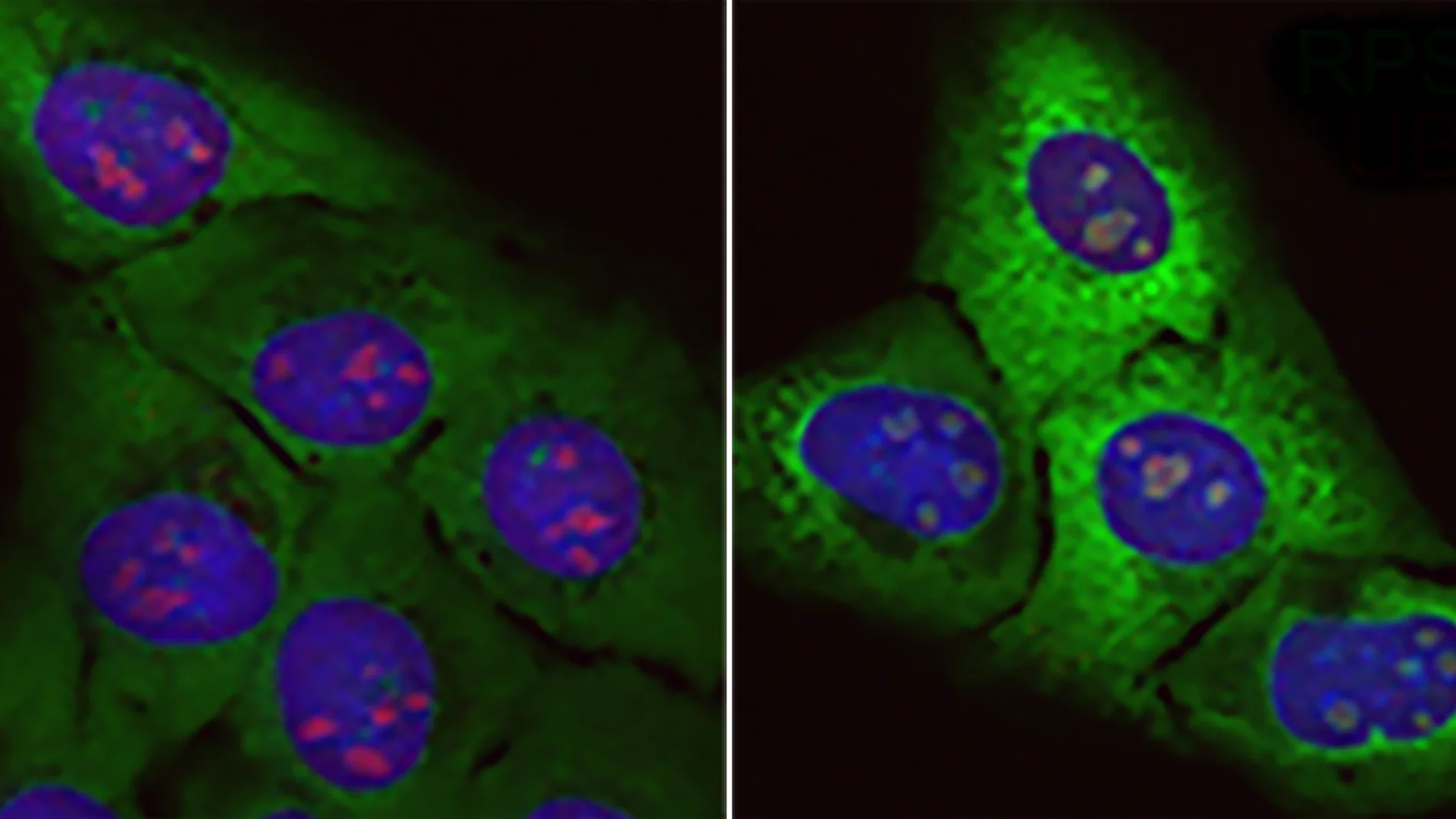 acumulación de proteínas basura acumulación de proteínas basura