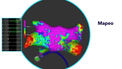 Pionero tratamiento de la fibrilación auricular persistente El Hospital Gregorio Marañón aplica por primera vez en España un nuevo tratamiento de fibrilación auricular persistente