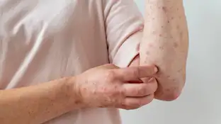 Mujer con sarampión Mujer con sarampión