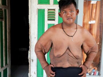 Imagen del indonesio Arya Permana, el que fue 'el niño más obeso del mundo'