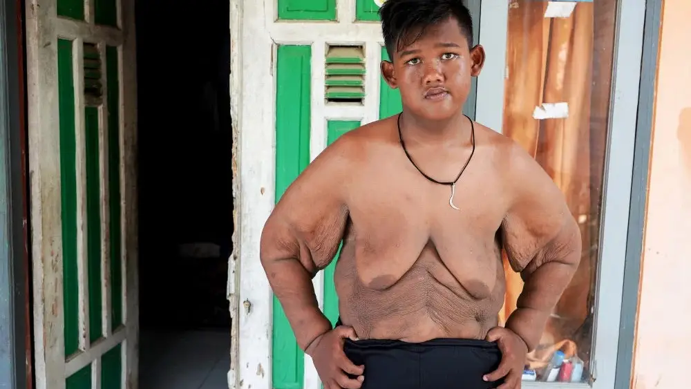 Imagen del indonesio Arya Permana, el que fue 'el ni&ntilde;o m&aacute;s obeso del mundo'