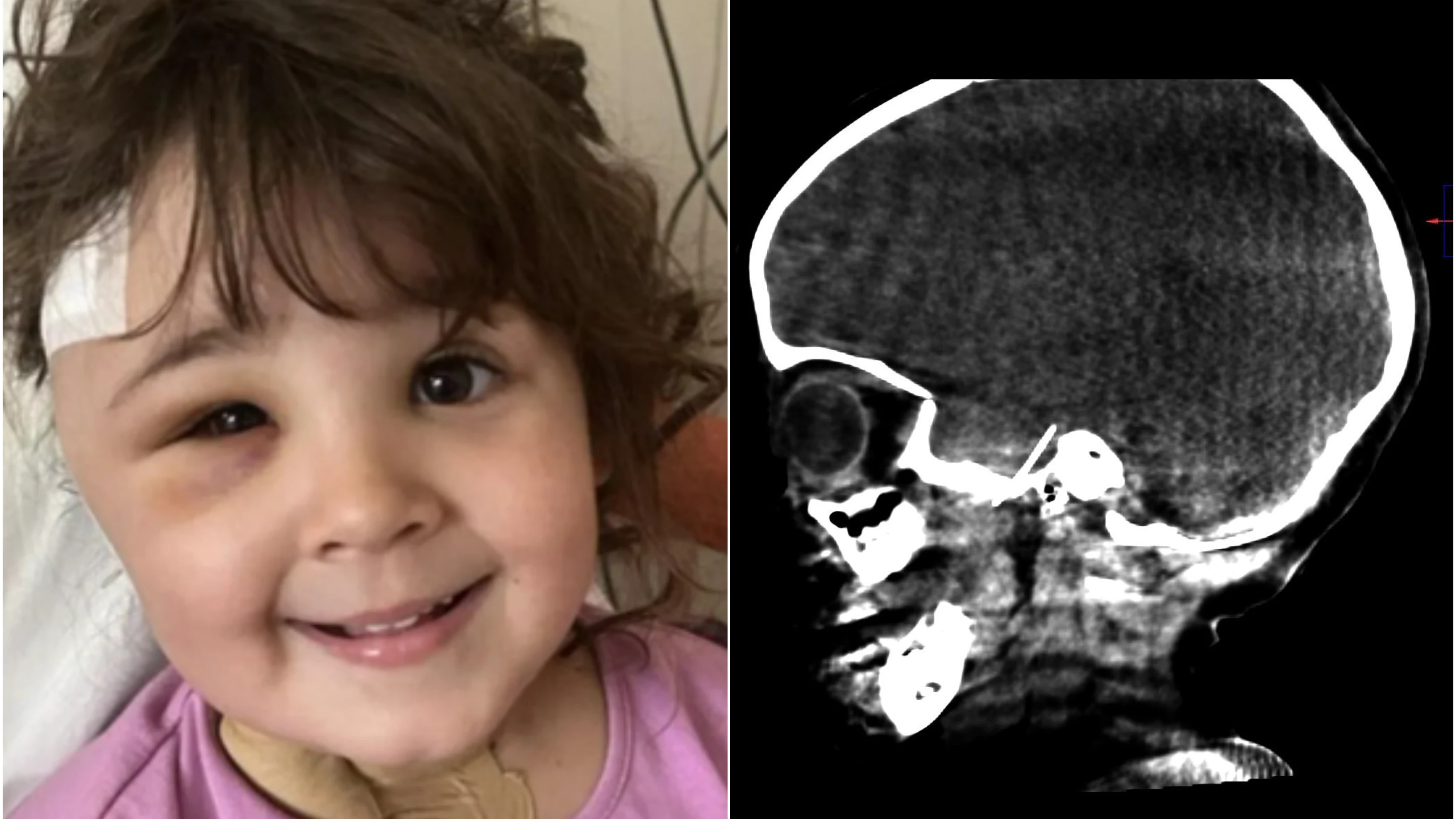 Radiografía de la niña con la aguja en el cráneo Radiografía de la niña con la aguja en el cráneo