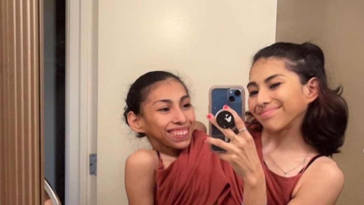 Las gemelas siamesas Carmen y Lupita revelan cómo sienten el sexo y qué pasará cuando una de ellas muera