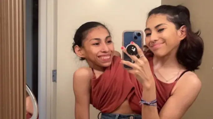 Las gemelas siamesas, Carmen y Lupita Andrade, tienen gustos muy diferentes. Las gemelas siamesas, Carmen y Lupita Andrade, tienen gustos muy diferentes.