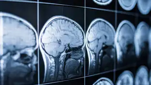 neuroimagen del cerebro neuroimagen del cerebro