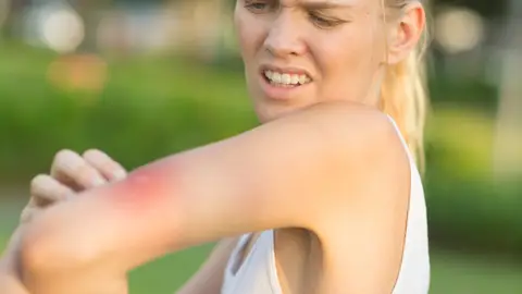 Picadura de mosquito Picadura de mosquito