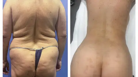 Resultados de LipoVáser y lipotransferencia Resultados de LipoVáser y lipotransferencia
