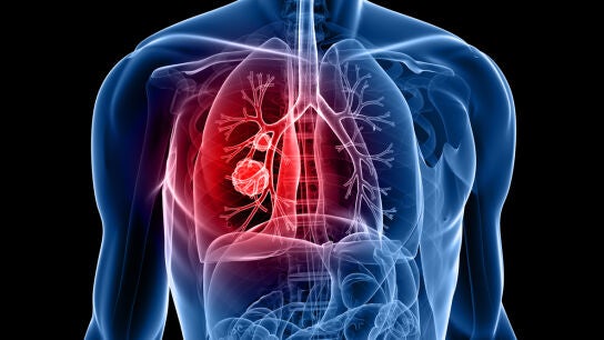 C&aacute;ncer de pulm&oacute;n