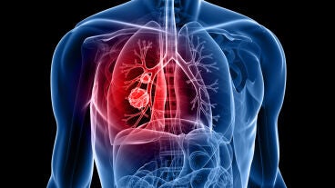 C&aacute;ncer de pulm&oacute;n
