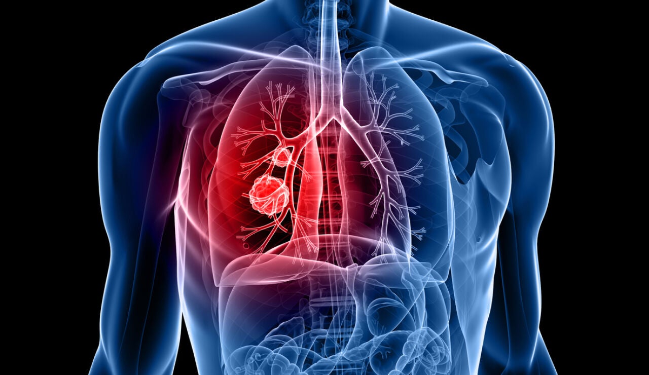 C&aacute;ncer de pulm&oacute;n