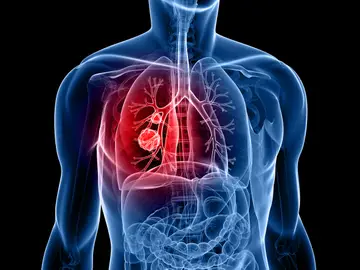 Cáncer de pulmón Cáncer de pulmón