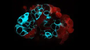 Organoide de tumor colorrectal Organoide de tumor colorrectal