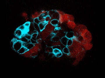 Organoide de tumor colorrectal Organoide de tumor colorrectal