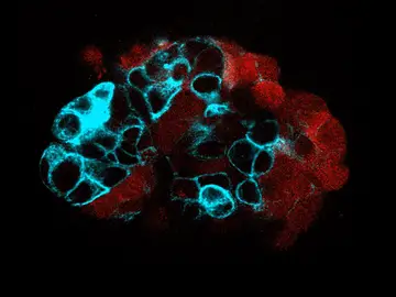 Organoide de tumor colorrectal Organoide de tumor colorrectal