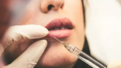 Bótox en los labios Bótox en los labios