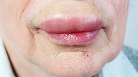 Labio hinchado por retoque estético Labio hinchado por retoque estético