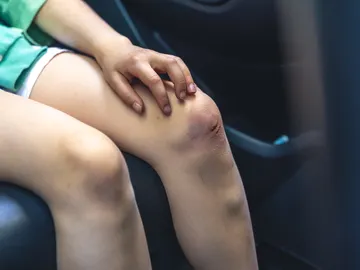Herida en la rodilla Herida en la rodilla